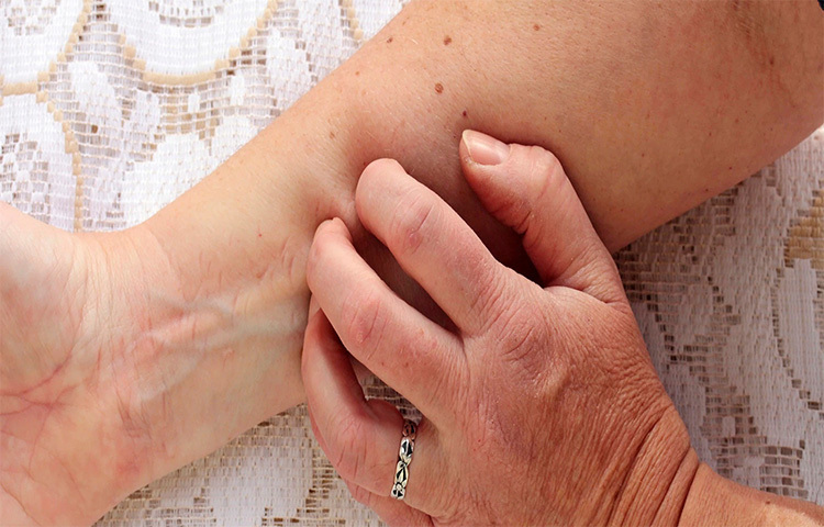 অ্যালার্জির সমস্যা: অনেকেরই প্রতি মৌসুমে অ্যালার্জির সমস্যা দেখা দেয়। এর ফলে তাদের মৌসুম বদলের সময় জ্বর হওয়ার সম্ভাবনাও থাকে। যদি আপনার চোখে সব সময় পানি পড়তে থাকে, কোনো খাদ্যের প্রতিক্রিয়ার ফলে ত্বকে ফুসকুড়িদেখা দেয়, তবে এটি আপনার রোগ প্রতিরোধ ক্ষমতা দুর্বল থাকার লক্ষণ হতে পারে। ছবি: সংগৃহীত