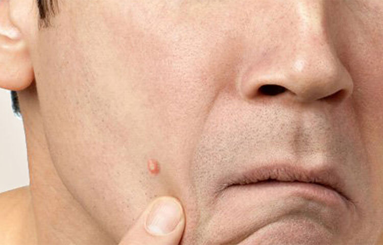 সকালে মুখে নিয়মিত সামান্য ফিটকিরি লাগিয়ে পানি দিয়ে ধুয়ে নিলেও উপকার পাওয়া যাবে। মুখে ব্রণ দেখা দিলেও তা কমে যাবে। ছবি: সংগৃহীত