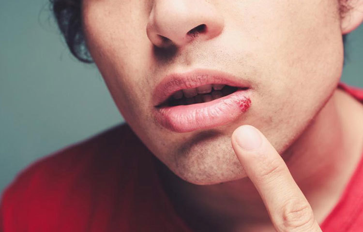 অ্যান্টি ভাইরাল উপাদান সমৃদ্ধ টি ট্রি অয়েল তুলোয় নিয়ে জ্বর ঠোসায় লাগান। দিনে বেশ কয়েকবার লাগান আর ভাইরাসের সংক্রমণ ঠেকিয়ে সেরে উঠুন।