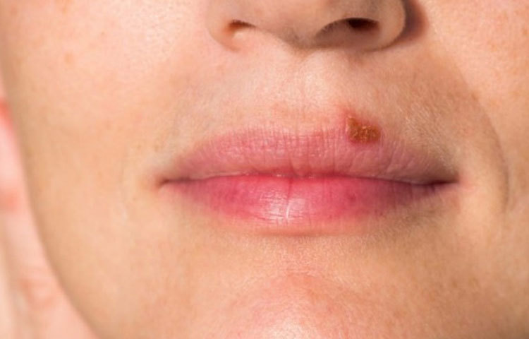 রসুনের কোয়া বেটে সরাসরি ক্ষত স্থানে দিনে অন্তত দুই থেকে তিনবার লাগান। দেখবেন দ্রুত উপকার পাবেন।