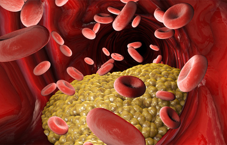 দেহে কোলস্টেরল দুই ধরনের হয়। ভালো কোলেস্টেরল যা কোষের গঠনে একান্ত প্রয়োজনীয়। শরীরে একাধিক হরমোনের সৃষ্টির জন্যও শরীরে ভালো কোলস্টেরল প্রয়োজন। অপরদিকে শরীরে খারাপ কোলস্টেরলের মাত্রা বেড়ে গেলে মারাত্মক প্রভাব পড়তে পারে। খারাপ কোলস্টেরলের জন্য স্ট্রোকের ঝুঁকি ও হৃদরোগের প্রবণতা বৃদ্ধি পায়। তবে তা এড়াতে পারেন খুব সহজেই। ছবি: সংগৃহীত