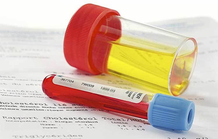 মূত্র ত্যাগের সময়, মূত্রের সঙ্গে রক্ত বের হলে সাবধান হন।