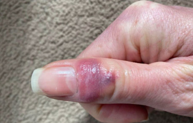 এই লক্ষণ বা উপসর্গ দেখে অনেকেই একে সাধারণত ত্বকের সমস্যা বা চর্মরোগ বলে ভুল করতে পারেন। তবে বিজ্ঞানীদের দাবি, এগুলো করোনার প্রাথমিক উপসর্গ হতে পারে!