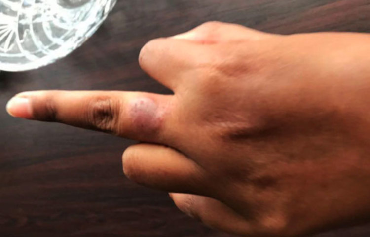 ‘কোভিড সিমটম স্টাডি’-র সঙ্গে যুক্ত গবেষকদের দাবি, হাত ও পায়ের আঙুলের উপর লালচে র‌্যাশ বা লালচে হয়ে ফুলে ওঠা করোনার প্রাথমিক উপসর্গ হতে পারে!