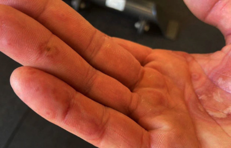 ‘কোভিড সিমটম স্টাডি’-র সঙ্গে যুক্ত গবেষকরা জানান, করোনার এই ধরনের উপসর্গ সাধারণত শিশু ও কিশোরদের মধ্যেই বেশি দেখা গিয়েছে।