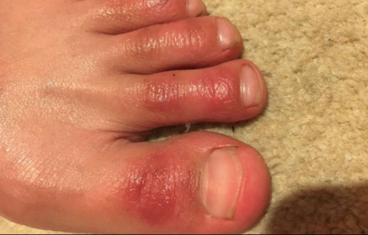 গবেষকদের মতে, এই ধরনের লালচে র‌্যাশ কোনও ত্বকের সমস্যা বা চর্মরোগের কারণেও হতে পারে। তবে হঠাৎ করে এই রকম র‌্যাশ বেরলে বা লালচে হয়ে ফুলে উঠলে পরীক্ষা করিয়ে নেওয়া জরুরি।