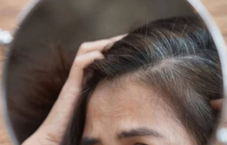 শ্বেতীর মতো অসুখও চুল পেকে যাওয়ার কারণ হতে পারে। এই অসুখে মেলানোসাইটস শরীর থেকে বিদায় নেয়। এই মেলানোসাইটসের জন্যই মেলানিন উৎপন্ন হয়। মেলানিন উৎপন্ন না হওয়ায় চুল অকালেই পেকে যায়। ছবি: সংগৃহীত