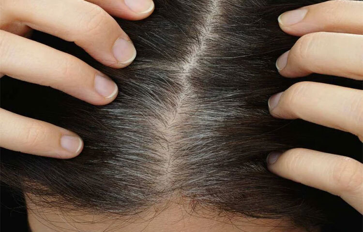 পাকা চুল হাত দিয়ে টেনে তোলার কারণে মাথার অন্যান্য চুল পাকে না। কিন্তু বিশেষজ্ঞদের মতে, আরও অন্যান্য কারণে পাকা চুল টেনে তোলা ঠিক নয়। তার প্রধান কারণ টেনে পাকা চুল তুললে সেখানে ত্বক সংক্রমণ দেখা দিতে পারে। ছবি: সংগৃহীত