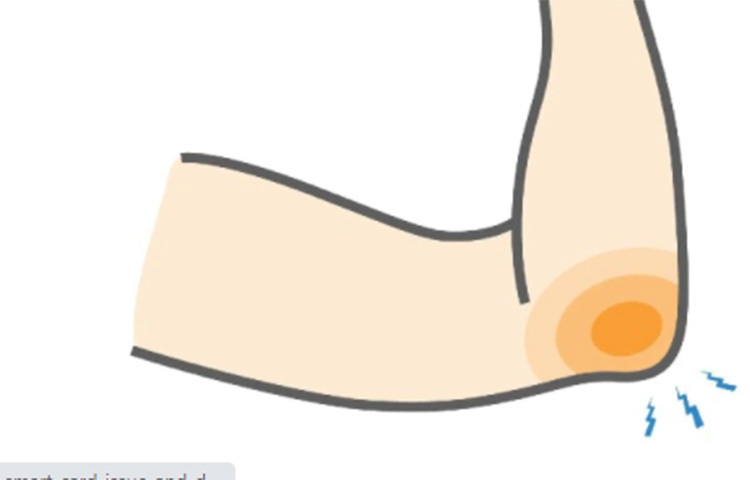 এই স্নায়ুর অধিকাংশ জায়গাতেই হাড়, পেশি ও চর্বি থাকে। তবে যখন এটি কনুইয়ের নিচের দিকে যায় তখন এটাকে একটি সরু পথ অতিক্রম করতে হয়। যার নাম ‘কিউবিটাল টানেল’। ছবি: সংগৃহীত