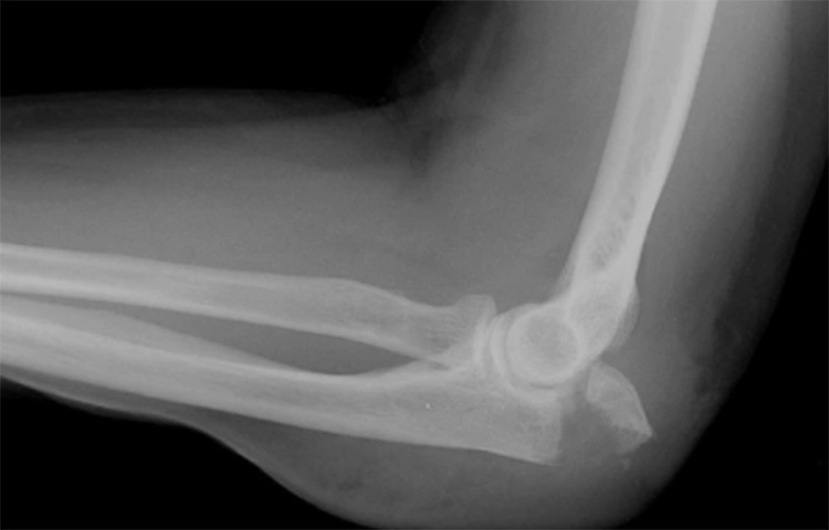 চিকিৎসকরা জানিয়েছেন, স্নায়ুটি যখন ওই টানেল অতিক্রম করে। তখনই সবচেয়ে বেশি সংবেদনশীল থাকে। তখন কিছুতে আঘাত লাগলে স্নায়ুটি সংকুচিত হয়ে যায়। ছবি: সংগৃহীত