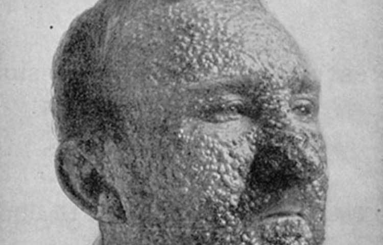 গুটি বসন্ত: ইউরোপ থেকে পঞ্চদশ শতকের শেষে এই অসুখটি ছড়িয়ে পড়ে আমেরিকায়। ক্রমে সারা বিশ্বেই মারণব্যাধি হিসেবে গুটি বসন্ত ভয়াবহ আকার ধারণ করে। এখন এই অসুখটি বিলুপ্ত বলেই জানা যায়।