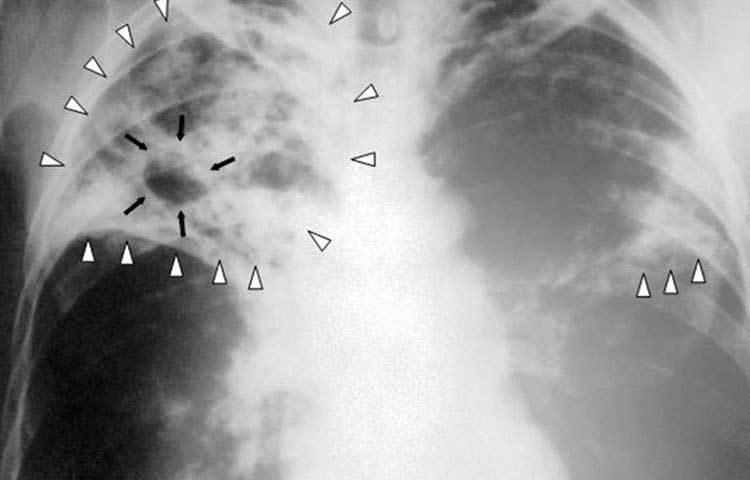 যক্ষ্মা: ব্যাকটেরিয়া বাহিত এই অসুখটি একসময় সারা পৃথিবীকে ভীত, সন্ত্রন্ত করে রেখেছিল। বর্তমানে এই অসুখকে অনেকটাই নিয়ন্ত্রণে আনা গিয়েছে।