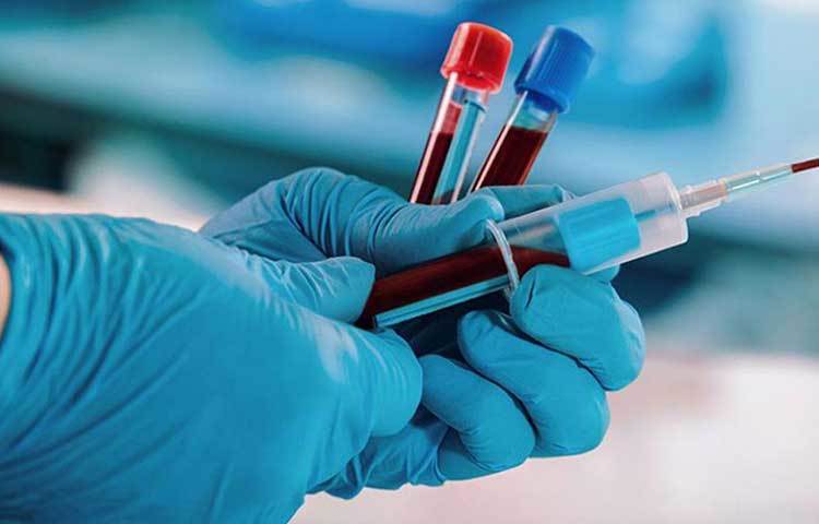 রক্ত পরীক্ষা: শরীরে কোনও রোগ-জীবাণু বাসা বাঁধলে রক্তের সংস্পর্শে তা আসবেই। কোভিড-১৯ ভাইরাস বাতাসবাহিত হয়ে ছড়িয়ে পড়ে বলে গলা ব্যথা ও সর্দির মাধ্যমে এই অসুখের সূত্রপাত হওয়ার আশঙ্কা বেশি থাকে। সঙ্গে জ্বর তো থাকেই। শরীরে রক্তের মধ্যেও এই ভাইরাস ছড়িয়ে পড়ে। তাই রোগীর রক্তের নমুনাও সংগ্রহ করা হয়ে থাকে।