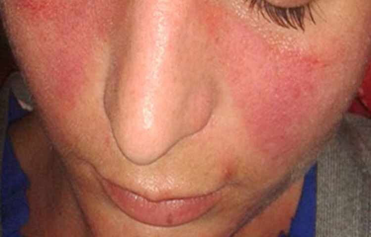 মাস্ক পরলে, বিশেষ করে গরমের এলাকায় মাস্ক পরলেই ঘাম হয়। আর যারা কাজের জন্য বা অন্য কোনো কারণে অনেকটা বেশি সময় ধরে মাস্ক পরে থাকেন, তাদের সমস্যা আরও বেশি হয়। ঘাম শুষে নেয়, এমন মাস্ক খুব কমই আছে। যেগুলো ঘাম শুষে নেয় না, সেগুলো পরলে অনেকেরই অ্যালার্জি, র‌্যাশ বা এক্সিমার মতো সমস্যা হচ্ছে। যার ফলে তারা মাস্ক পরা থেকে বিরত থাকছেন। কিন্তু চিকিৎসকরা বলছেন, জীবনে বেঁচে থাকা জন্য সাময়িক ছোট কোনো সমস্যা এড়িয়ে যাওয়া যায়। আর র‌্যাশ হওয়া বা অ্যালার্জি, এগুলো কিছু জিনিস মেনে চললে কম হতে পারে।