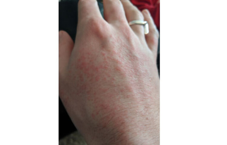 র‌্যাশ হলে তাতে হাত না দেওয়া। র‌্যাশ হলেই চুলকাতে ইচ্ছে করে। যার জন্য খুব স্বাভাবিকভাবেই সেখানে হাত চলে যায়। চুলকালে বা র‌্যাশে হাত দিলে তা দ্বিগুণ বেড়ে যায়। তাই হাত না দিলে ভালো। আর যদি খুব চুলকায়, তা হলে চিকিৎসকের পরামর্শ নেয়া উচিত।