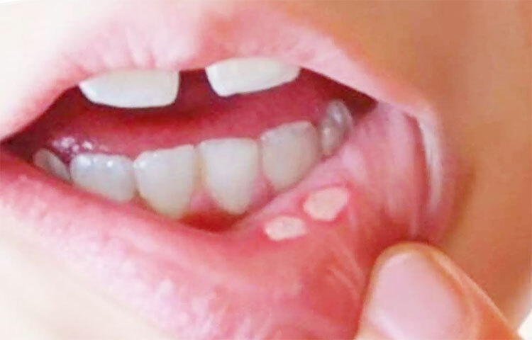 টুথপেস্ট, মাউথওয়াশে সোডিয়াম লরেল সালফেটের মতো উপাদান থাকলে মাউথ আলসারের ঝুঁকি বেড়ে যায়। ছবি: সংগৃহীত