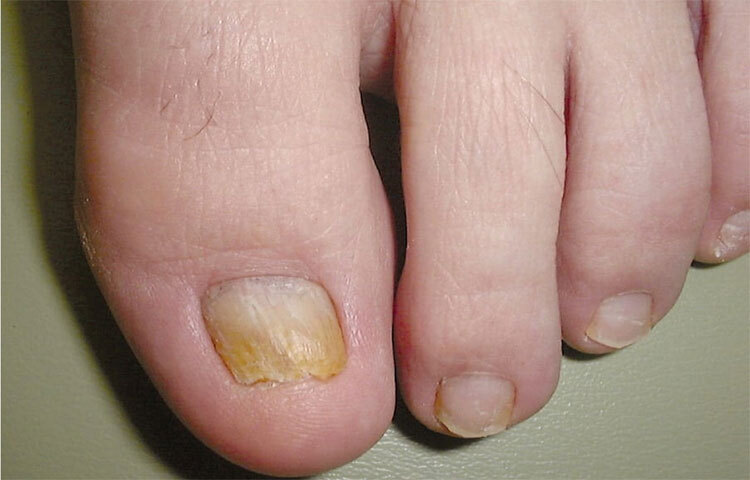 নখ যদি সবুজ বা ধূসর হয়ে যায়: নখ ধূসর হয়ে যাওয়া বা সবুজ হয়ে যাওয়া রক্তপ্রবাহের সমস্যার লক্ষণ হতে পারে। এর ফলে শিরা বা ধমনীতে সাময়িক যন্ত্রণাও দেখা দিতে পারে। ছবি: সংগৃহীত