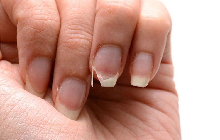 আঙুলের ডগাগুলো যদি ফুলে যায়: আঙুলের ডগাগুলি যদি আঙুলের অন্য অংশের থেকে বেশি স্ফীত হয় তাহলে অনেক সময়েই তা হার্টের বা ফুসফুসের রোগের লক্ষণ। এটি অনেক ক্ষেত্রেই রক্তে অক্সিজেনের স্বল্পতারও উপসর্গ। ছবি: সংগৃহীত