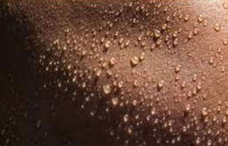 অ্যাংজাইটি বা উদ্বেগে ভোগার অন্যতম লক্ষণ এটি। প্রথমেই সাবধান হোন। এর চিকিৎসার জন্য চিকিৎসক আপনাকে অ্যান্টি অ্যাংজাইটি ওষুধ দিতে পারে। ছবি: সংগৃহীত