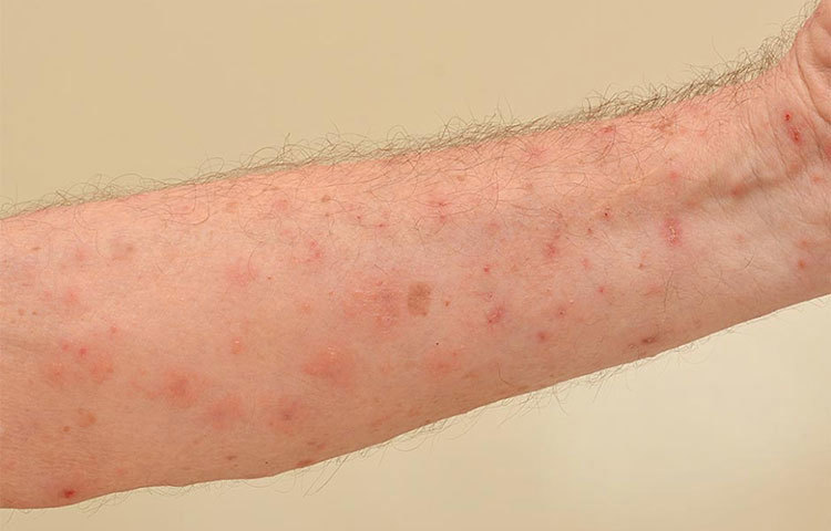 ত্বকে বিভিন্ন ধরনের রোগ হয়। কাঁচা হলুদ বাটার সঙ্গে নিমপাতা বাটা মিশিয়ে ব্যবহার করুন।