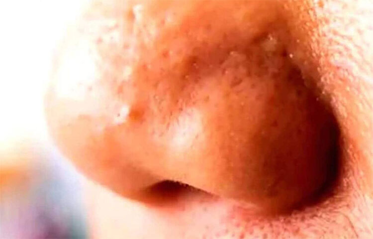 হাজারো প্রসাধনীর পিছনে ছুটলেও ভুলে যাই হাতের কাছেই আছে ঘরোয়া সমাধান। লেবুতে আছে এক্সফোলিয়েটিং উপাদান। ত্বক থেকে বাড়তি তেল শুষে নেয় লেবুর রস। নাকে লেবুর রস লাগিয়ে ১৫ মিনিট অপেক্ষা করুন। তারপর ধুয়ে ফেলুন। ছবি: সংগৃহীত