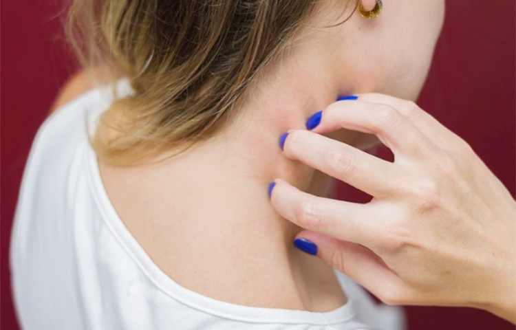 ঘামাচি প্রতিরোধে বরফ ভালো কাজ করে। বরফ একটি কাপড়ে পেঁচিয়ে ঘামাচির স্থানে ৫ থেকে ১০ মিনিট সেঁক দিন। এটি ঘামাচি মেরে ফেলে লাল হওয়া কমিয়ে দিয়ে থাকে। ছবি: সংগৃহীত