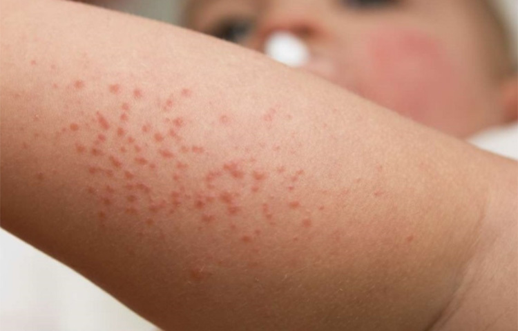 বেসন ও পানি মিশিয়ে পেস্ট তৈরি করুন। এই পেস্টটি ঘামাচির স্থানে লাগিয়ে নিন। ১৫ মিনিট পর শুকিয়ে গেলে ঠান্ডা পানি দিয়ে ধুয়ে ফেলুন। এটি চুলকানি দূর করে ঘামাচি দূর করে দেবে। ছবি: সংগৃহীত