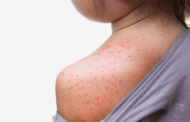 নানা ভেষজ গুণে সমৃদ্ধ মুলতানি মাটির সঙ্গে দুই অথবা তিন টেবিল চামচ গোলাপ পানি মিশিয়ে ঘন পেস্ট তৈরি করুন। এই পেস্টটি ঘামাচির স্থানে লাগিয়ে নিন। শুকিয়ে গেলে ঠান্ডা পানি দিয়ে ধুয়ে ফেলুন। এক মুঠো নিমপাতা গুঁড়ো করে পেস্ট তৈরি করে নিন। এই পেস্টটি ঘামাচির স্থানে লাগিয়ে নিন। শুকিয়ে গেলে ঠান্ডা পানি দিয়ে ধুয়ে ফেলুন। ছবি: সংগৃহীত