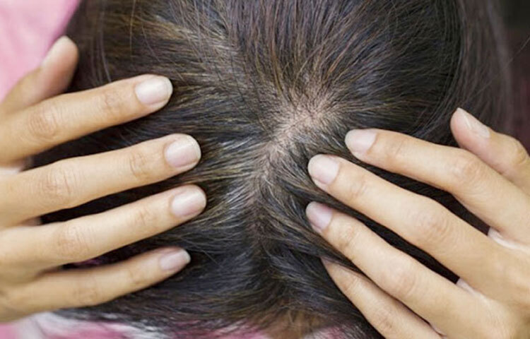 শরীরে প্রোটিনের ঘাটতি হলে তার প্রভাব পড়ে চুল ও নখে। ছবি: সংগৃহীত