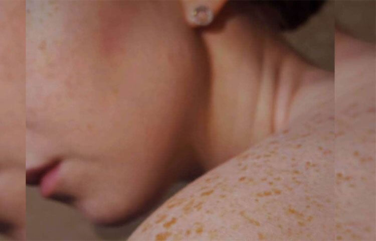 অল্প আঘাত যদি বড় সংক্রমণে রূপান্তরিত হয়, তাহলেও হয়তো আপনি প্রোটিনের অভাবে আক্রান্ত। ছবি: সংগৃহীত