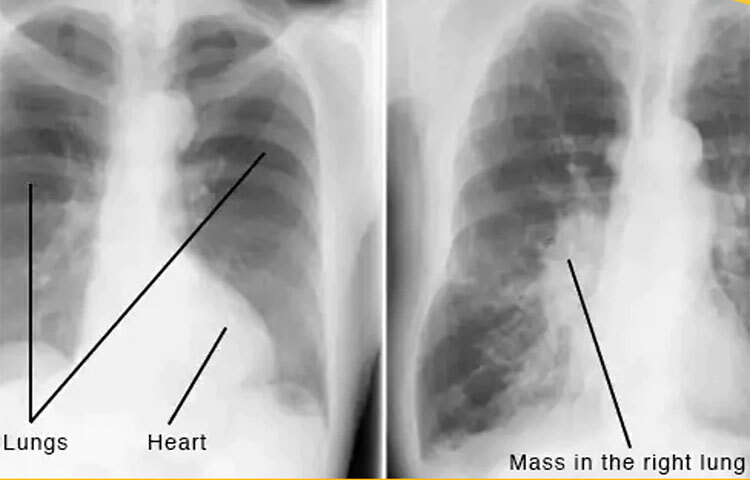 এক্স-রে: প্রত্যেক ধূমপায়ীদের জন্য এই পরীক্ষা আবশ্যিক। এই পরীক্ষাটি মূলত ধূমপানের ফলে স্বাস্থ্যের কতটা ক্ষতি হয়েছে তা দেখার জন্য করা হয়। এক্স-রের মাধ্যমে রোগীর ফুসফুস ও হৃদপিন্ডের ছবি নেওয়া হয়ে থাকে। যার মাধ্যমে তার রক্তনালী, অবরুদ্ধ ধমনী নিকোটিনের ধোয়ার কারণের কতটুকু ক্ষতিগ্রস্ত হয়েছে তা জানা যায়। এবং সেই অনুযায়ী তার চিকিৎসা করা হয়। ছবি: সংগৃহীত