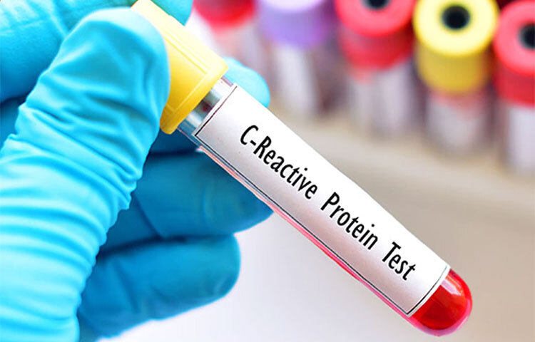 এইচএস-সিআরপি টেস্ট: এটি মূলত একটি রক্ত পরীক্ষা। যা শরীরে প্রোটিনের স্তর বা পরিমাণ বুঝতে নির্ণয় করানো হয়। এই এইএস-সিআরপি পরীক্ষাটি যাদের এরই মধ্যে হৃদরোগ নেই তাদের হৃদরোগের ঝুঁকি বা স্ট্রোকের ঝুঁকি কতখানি তা বুঝতে ব্যবহার করা হয়। ছবি: সংগৃহীত