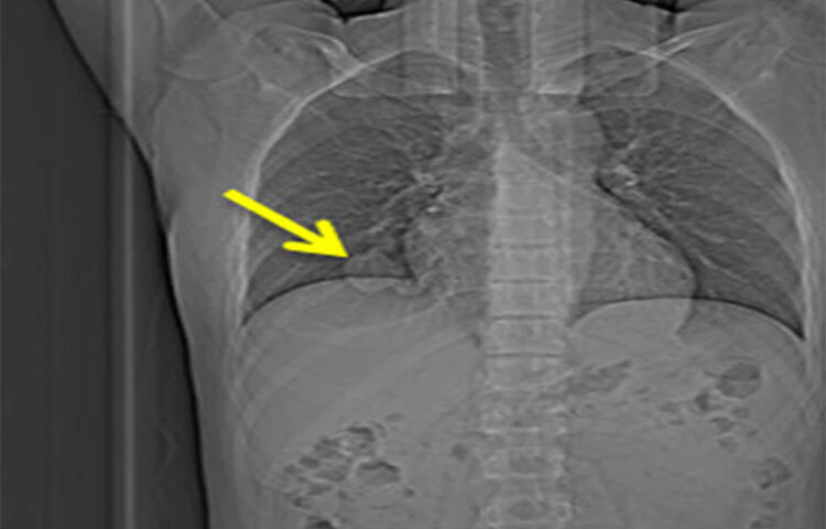 সিটি স্ক্যান মূলত ফুসফুসের ক্যান্সারের মতো জটিল রোগ চিহ্নিত করতে সাহায্য করে। প্রাথমিক পর্যায়ে ক্যান্সার ধরা পড়লে তা অস্ত্রোপচারের মাধ্যমে নিরাময় করা সম্ভব। তবে তা শেষ পর্যায়ের কাছাকাছি পৌঁছে গেলে তা আর সারিয়ে তোলা সম্ভব নয়। যারা মূলত চেইন স্মোকার তাদের জন্য এই পরীক্ষাটি একটি নির্দিষ্ট সময় অন্তর করানো আবশ্যক। ছবি: সংগৃহীত