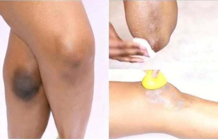 মিনিট দশেক পর চিনির রস টেনে গেলে ধুয়ে নিন। সপ্তাহে তিন-চারবার এই প্যাক লাগালে দুতিন মাসের মধ্যেই দাগ অনেকটা হালকা হয়ে এক সময় উঠে যাবে। ছবি: সংগৃহীত