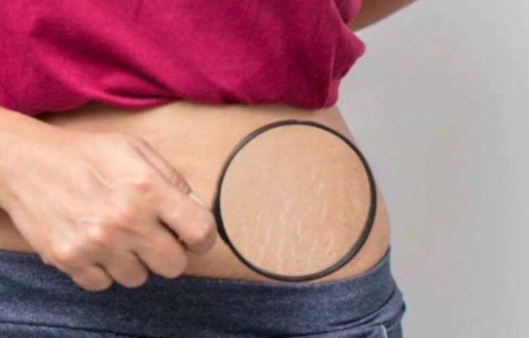 কোমড়ে, পেটে, হাতে বা পায়ে স্ট্রেচ মার্কসের জন্য অনেক পছন্দসই পোশাক পড়তে সমস্যায় পড়তে হয়। এ ক্ষেত্রে এমন বেশ কয়েকটি ঘরোয়া উপায় রয়েছে যেগুলো কাজে লাগিয়ে সহজেই স্ট্রেচ মার্কস দূর করা যায়।