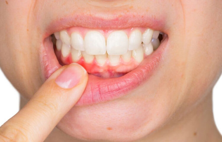 মাড়ি অসুস্থ হওয়ার বেশ কয়েকটি কারণ রয়েছে। যেমন, সঠিকভাবে দাঁত না মাজা, মুখ না ধুয়ে ঘুমানো, ধূমপান বা অতিরিক্ত মিষ্টি খাওয়ার কারণে মাড়ির ক্ষতি হতে পারে। যদি সময়মতো ডাক্তার না দেখানো হয়, তাহলে বিপদ হতে পারে। ছবি: সংগৃহীত