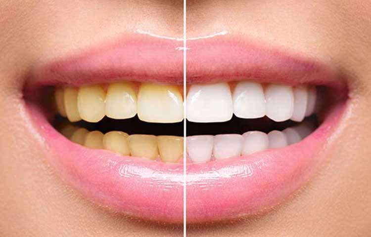 হলদেটে দাঁত ঝকঝকে সাদা করতে হলুদ বেশ কার্যকরী একটি উপাদান। দাঁত ব্রাশ করার সময় পেস্টের সঙ্গে সামান্য হলুদ গুঁড়ো দিয়ে নিন। এইভাবে নিয়মিত দাঁত ব্রাশ করলে দাঁতের হলদেটেভাব কেটে যাবে।