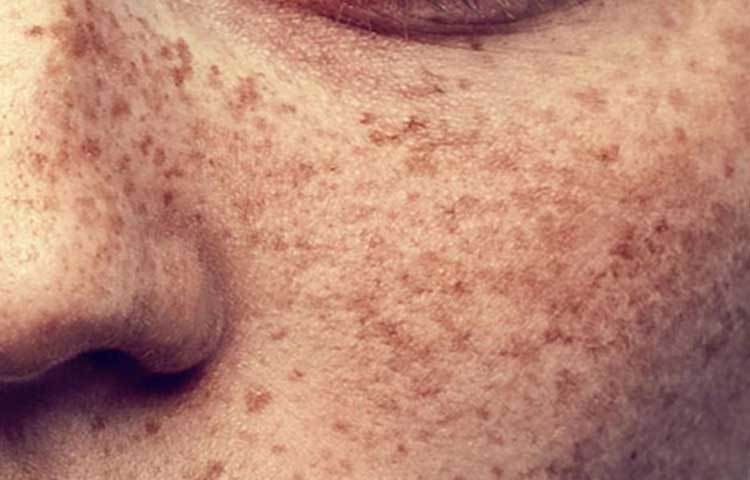 মুখের বা ত্বকের কালচে দাগ দূর করতে হলুদ খুবই উপকারী। একটি পাত্রে এক কাপ দুধ নিয়ে তার মধ্যে ১ চামচ হলুদ গুঁড়ো ও ১ চামচ নুন মেশান। এবার মিশ্রণটি ত্বকের কালচে দাগের ওপর লাগিয়ে অন্তত ১৫ মিনিট রেখে দিন। তারপর মুখ ধুয়ে ফেলুন। উপকার পাবেন।