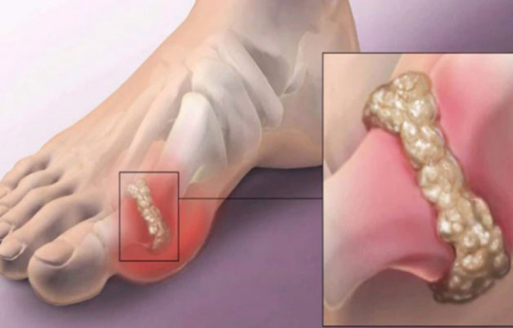 ইউরিক অ্যাসিডের মাত্রা নিয়ন্ত্রণে লাল মাংস (রেড মিট), লাল মদ (রম), সামুদ্রিক মাছ কম খাওয়া উচিৎ। উচ্চ প্রোটিন যুক্ত খাবার, যেমন মাছ-মাংস, মুসুড়ির ডাল, রাজমা, কিছু সবুজ সবজি (পালং শাক) এড়িয়ে চলুন।