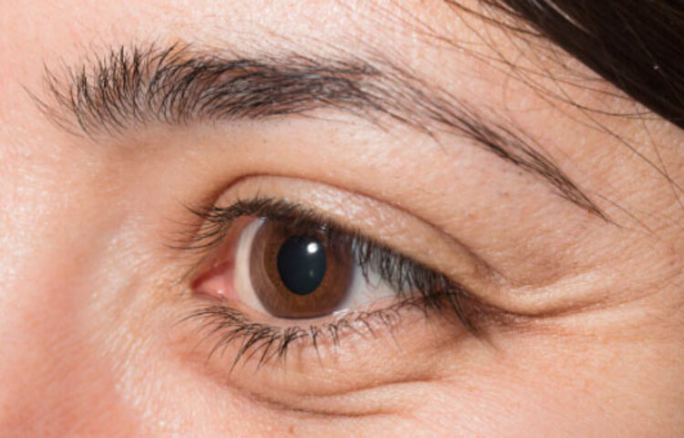 পাফি আইজ বা চোখের কোল যদি ফোলা থাকে বুঝবেন শরীরে ভিটামিনের অভাব রয়েছে।