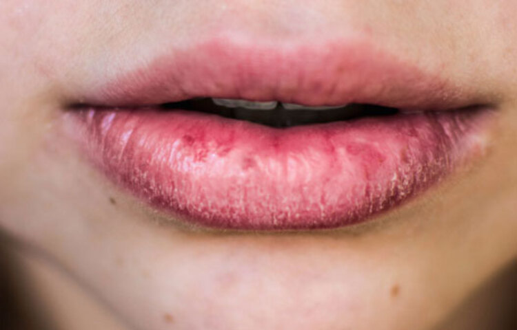 ঠোঁট ফাটা বা শুকিয়ে যাওয়াও ভিটামিনের অভাবের লক্ষণ।