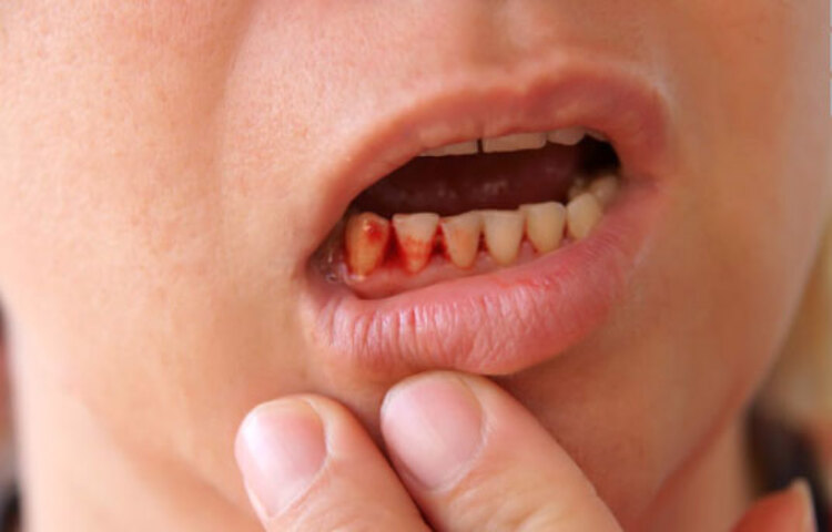 মাড়ি থেকে রক্ত বেরলেও বুঝবেন শরীরে ভিটামিনের অভাব রয়েছে।