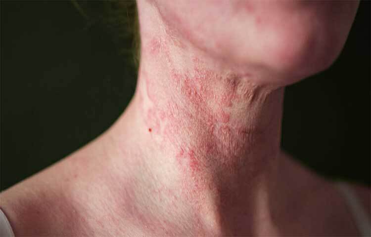 শীতের সময় শুষ্কতার কারণে শরীরের ত্বক ও শুষ্ক হয়ে ওঠে। ফলে অনেক সময় চুলকানি বা ব্যথা অনুভব হতে পারে। অ্যালার্জির কারণে অনেক সময় তীব্র শ্বাসকষ্টও হতে পারে। কোল্ড বা ডাস্ট অ্যালার্জির সমস্যা ছাড়াও শীতের শুষ্ক আবহাওয়ায় ত্বকের আর্দ্রতা কমে গিয়ে ত্বক রুক্ষ ও শুষ্ক হয়ে যায়।