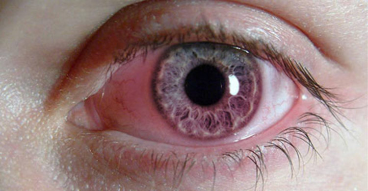 চোখ ওঠায় করণীয়