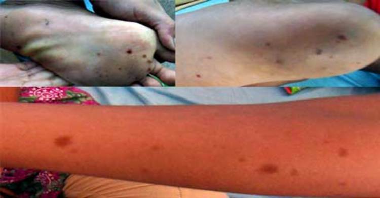 নওগাঁয় অর্ধশত শিক্ষার্থী অজানা রোগে আক্রান্ত