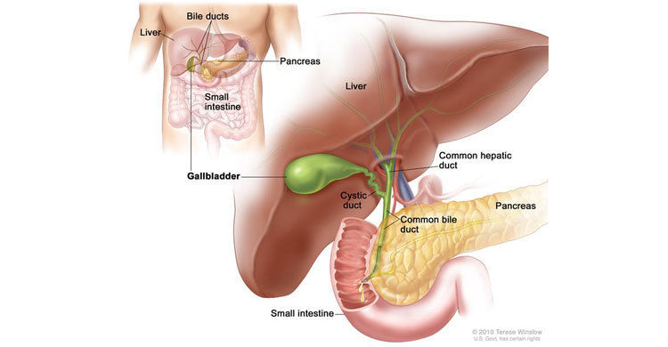 পিত্তথলিতে পাথর হলে কী করবেন