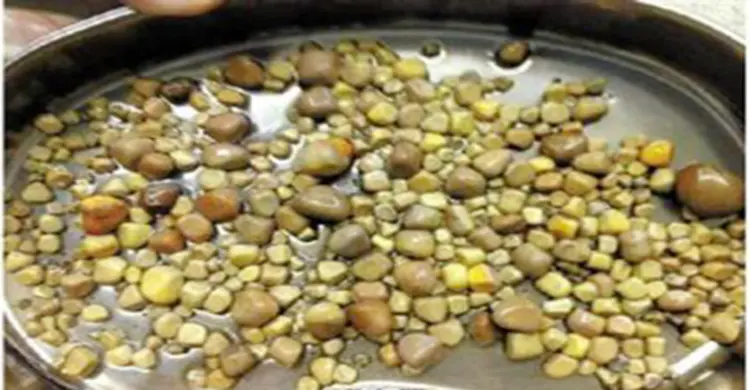মানুষের কিডনিতে ৪২০টি পাথর!