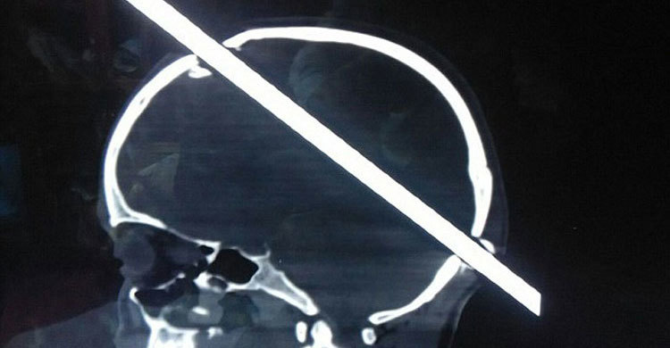 মাথা ভেদ করে গেল লোহার রড : তবুও বেঁচে নির্মাণশ্রমিক