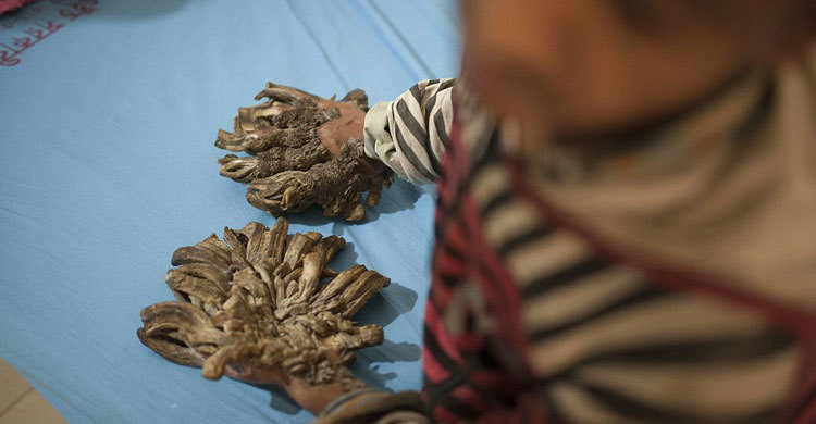 বৃক্ষ মানবের প্রথম অস্ত্রোপচার শনিবার