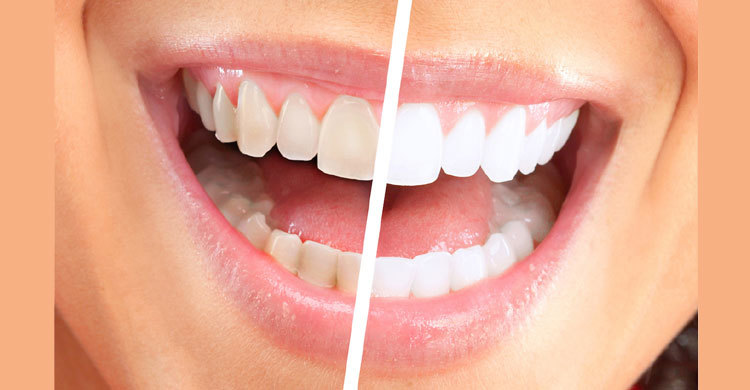 দাঁতের হলদেটে ভাব দূর করতে যা খাবেন